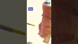 All-on-X Implants & Dentures Explained!