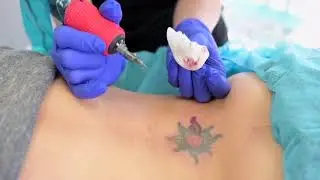 TATTOOREMOVAL.CLINIC | TORONTO - THE UNDO&trade; NON-LASER TATTOO REMOVAL SYSTEM. Call 647-559-3662