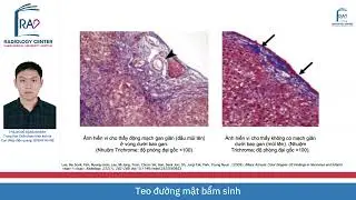 TEO ĐƯỜNG MẬT BẨM SINH