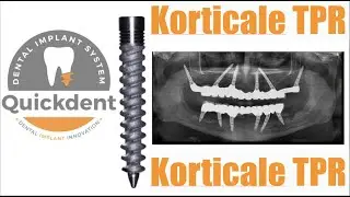 Quickdent Korticale TPR - Patented Design Hybridimplant | basal implants vs conventional implants