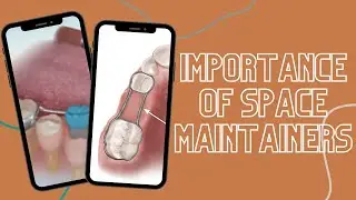 Importance of Space Maintainers #shorts
