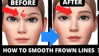 No Botox! Remove Frown Lines Naturally | Smooth Frown Lines in 14 days with face yoga!