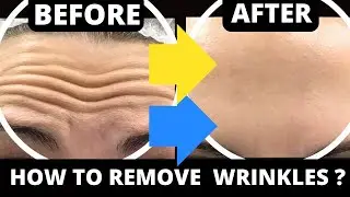 Erase Forehead Wrinkles with Easy Face Yoga Exercises No Botox!