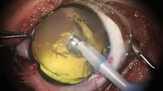 In-the-bag phacoemulsification of luxated lens & sulcus fixation of IOL through a 3mm incision