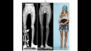 Systematic Utilitarian Procedure for Extremity Reconstruction SUPER