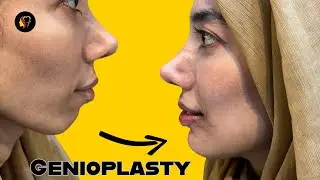 Genioplasty | Chin Surgery to improve facial profile, explained | Aldaim Dental Center 