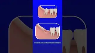 Wisdom Teeth Removal: When Is It Really Necessary? #braces #wisdomtoothremoval #youtubeshorts