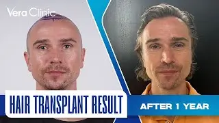 Receding Hairline Transformation | 3,545 Graft FUE Hair Transplant at Vera Clinic