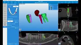 RealGUIDE Software   Teeth Segmentation