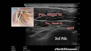 Sonographic Landmarks of the 2nd & 3rd Ribs