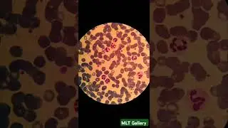 Hypersegmented neutrophils in peripheral blood smear