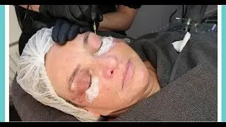 Plasma Lift - Beauty Hits