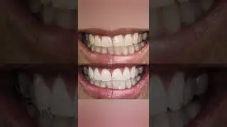 3 Things I wish I had implemented sooner in my teeth whitening business. #shorts #teethwhitening