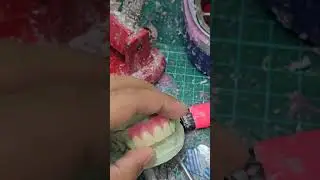 4 unit Rpd #nakhlidaant #teeth #daantsaaf #daant #dard #painlesssurgery #dentistry #youtubeshorts
