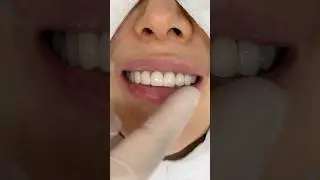 allceramic crowns rework