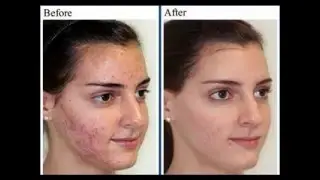 Clear Pores - Natural Home Remedies To Close Open Pores