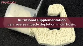 Understanding Muscle Loss in Liver Cirrhosis