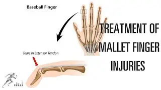Mallet finger: Treatment of this difficult finger injury