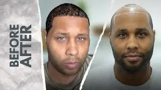 Afro-American Male 1 Year Hair Transplant Result - 3700 Grafts - Norwood 6 Hair Loss at Heva Clinic