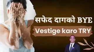 Manage Vitiligo (Safed Daag / કોડ ) with Vestige Supplements + Best Diet Tips Manish Patel