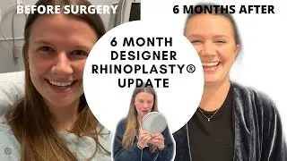 6 MONTHS AFTER DESIGNER RHINOPLASTY!
