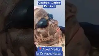 Carbon laser | Best Facial | Hollywood facial | Glow Facial