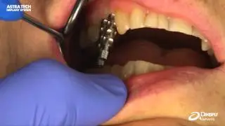 Astra Tech Implant System EV - Impression taking procedure using Uni Abutment EV Pick-Up