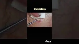 Strange Bugs in Man's body.....
