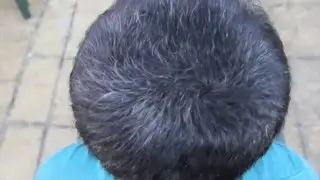 Hair Loss - Transformations | Gofybr Hair Loss Fibers