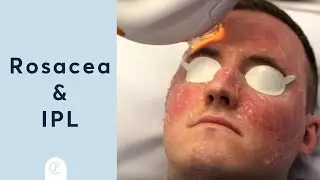 Rosacea Treatment at Pulse Light Clinic London