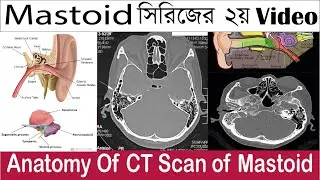 Video No:015. Mastoid Series: 2 of 5. ?CT Scan of Mastoid Anatomy.
