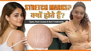 Stretch Marks क्यों होते हैं? Types, Real Causes & Best Treatments | Dr Aman Dua