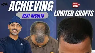 Hair Transplant In Chennai | Best Centre Results Surgeon & clinic Of Hair Transplant Of Chennai