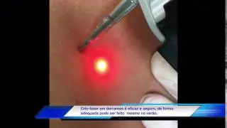 01- Crio-Laser, como &eacute; feito?