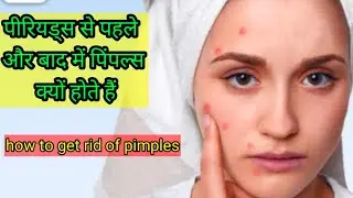 pimples before periods causes and treatments | Periods से पहले और बाद में पिंपल्स क्यों होते हैं |