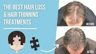 The Best Treatments for Hair Loss and Hair Thinning