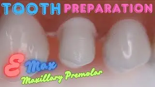 Tooth Preparation for Emax Crown on Maxillary First Premolar 🟡 Step By Step