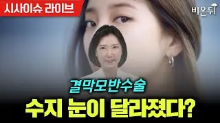 Suzy's eye changed? Conjunctival nevus surgery / Nune Eye Hospital, Dr. Han Hye-kyung