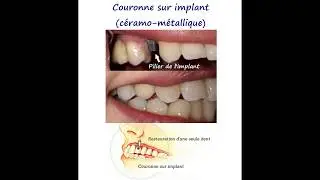 Pourquoi faut-il remplacer une dent manquante? Jildent Clinique - Budapest