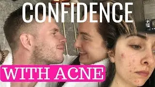 HOW TO HAVE CONFIDENCE WITH ACNE/ SCARRING/ PIGMENTATION