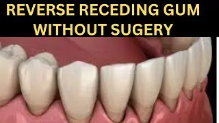 7 Best Ways For Receding Gum Treatment Naturally Without Surgery|Cure Receding Gum