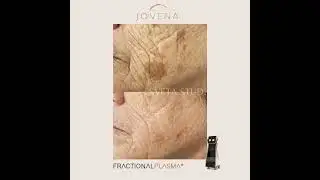 Smooth, Healthy and Luminous skin with Jovena &reg; Fractional Plasma!