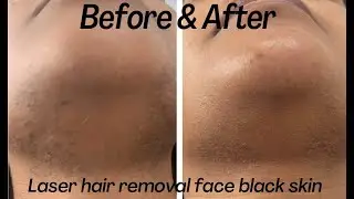 BEFORE & AFTER - Laser hair removal for black skin! Face treatment!