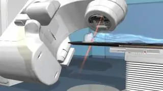 Head & Neck Cancer - Brain Tumor Treatment - Rapid Arc @ Orange County Cyberknife