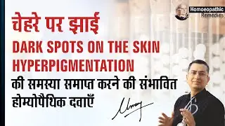 चेहरे पर झाईं II Hyperpigmentation II Melasma II Chloasma II Top Natural Homoeopathic Remedies