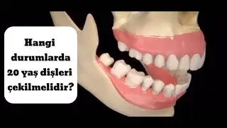 Her 20 yaş dişi &ccedil;ekilmeli mi ? #zirkonyumdiş  #dishekimi #hollywoodsmiles #antalyadişhekimi #dental