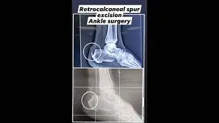 Heel bone pain treated with surgery #anklesurgery