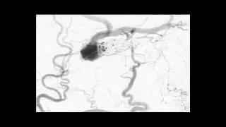 Technques Dural Fistula Case 2 coiling mid