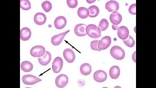 Morphology of Tear drop red blood cells (dacrocytes); Characteristics, Features, Structure