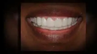 Cost of Snap On Dentures